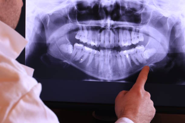 Best Knocked-Out Tooth (Avulsed Tooth) Treatment in Wright City, MO